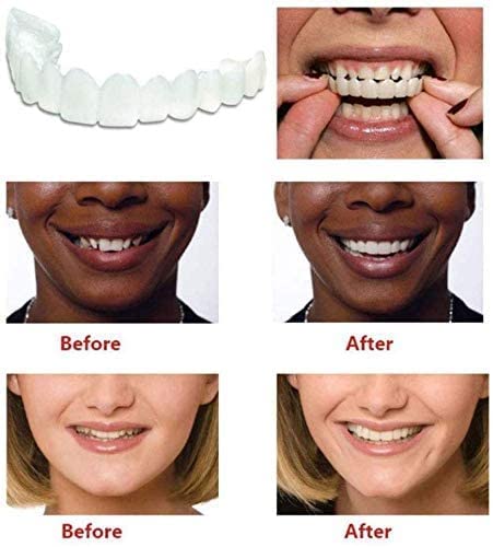 Adjustable Snap On Dentures - Smile Veneers - Doctors Recommended