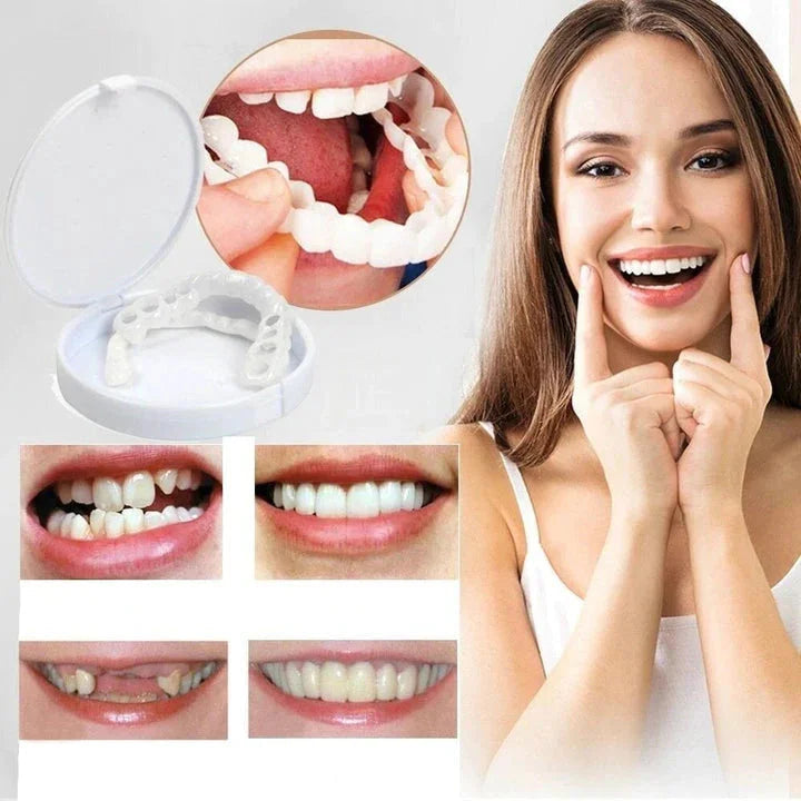 Snap-On Veneers Set for Upper & Lower Teeth with Custom Fit | Removable Solution for a Natural-Looking Smile