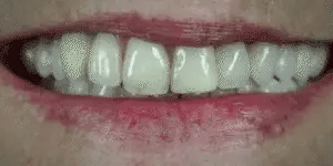 Snap-On Veneers Set for Upper & Lower Teeth with Custom Fit | Removable Solution for a Natural-Looking Smile