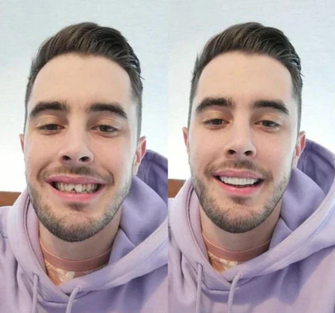 Snap-On Veneers Set for Upper & Lower Teeth with Custom Fit | Removable Solution for a Natural-Looking Smile