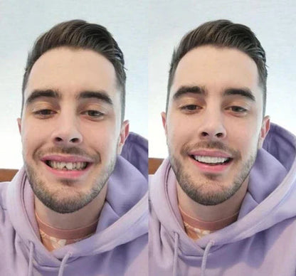 Snap-On Veneers Set for Upper & Lower Teeth with Custom Fit | Removable Solution for a Natural-Looking Smile