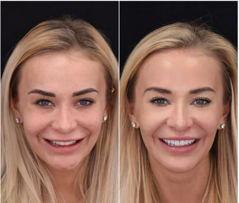 Snap-On Veneers Set for Upper & Lower Teeth with Custom Fit | Removable Solution for a Natural-Looking Smile