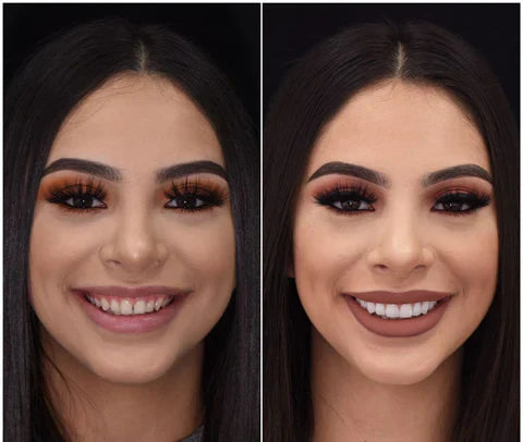 Snap-On Veneers Set for Upper & Lower Teeth with Custom Fit | Removable Solution for a Natural-Looking Smile