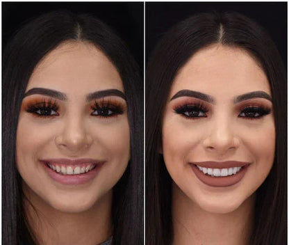Snap-On Veneers Set for Upper & Lower Teeth with Custom Fit | Removable Solution for a Natural-Looking Smile