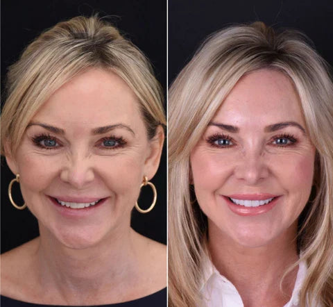 Snap-On Veneers Set for Upper & Lower Teeth with Custom Fit | Removable Solution for a Natural-Looking Smile
